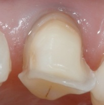« Les facettes céramiques » : diaporama sur Dental Life