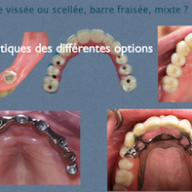 Le traitement de l’édenté complet en implantologie